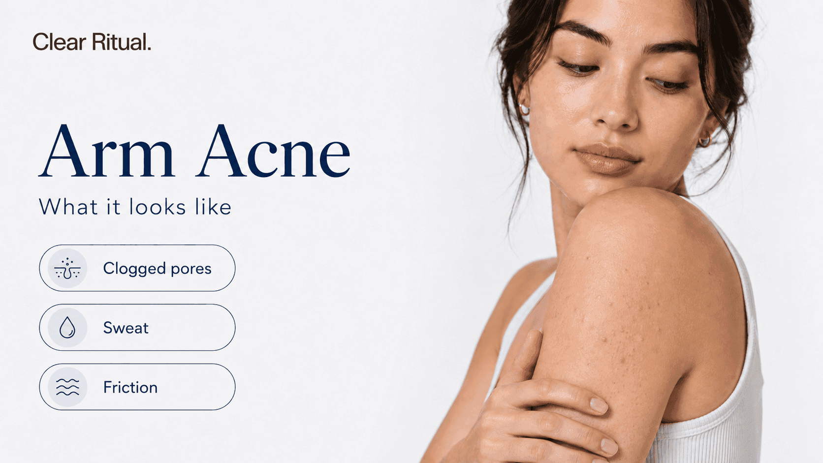Upper arm acne and bumps