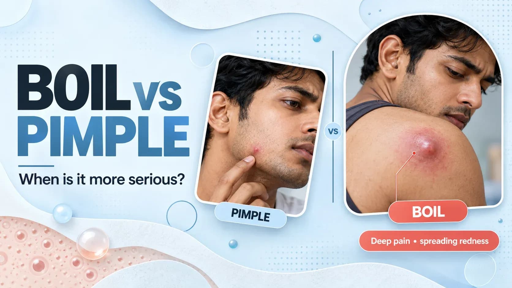 boils vs pimples