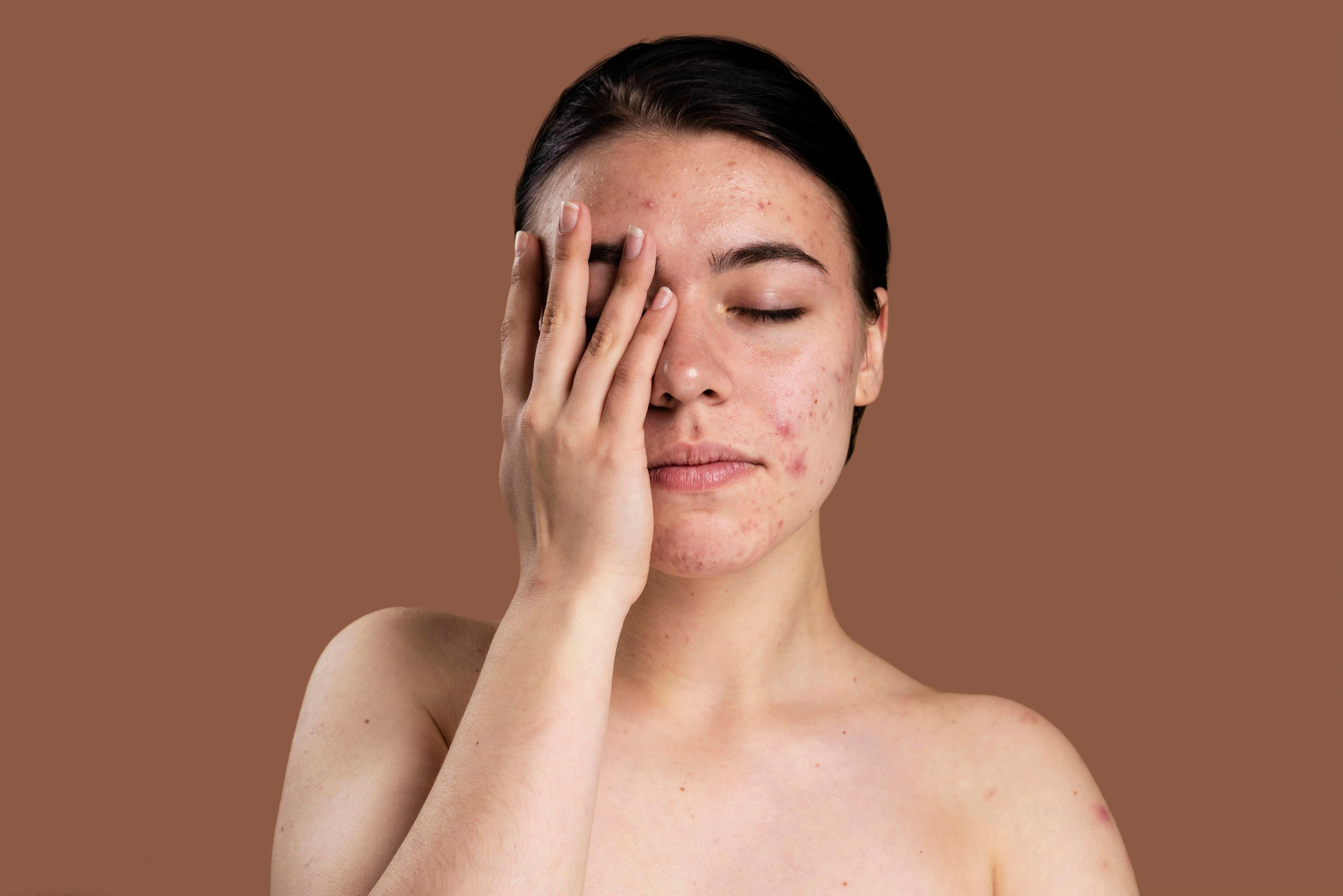Acne scars on skin texture