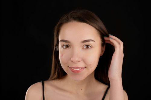 Fungal Acne: Causes, Symptoms, Treatment & Prevention Tips
