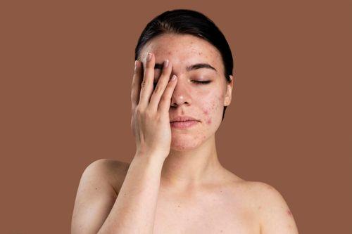 What Are Acne Scars? Types, Causes, and Best Treatments