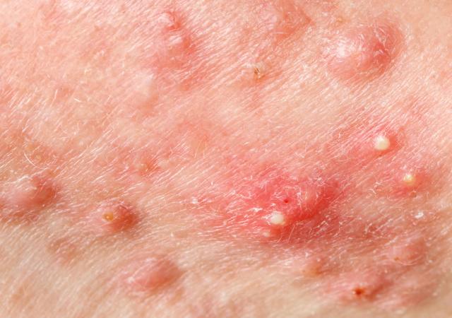 pus_filled_pimples