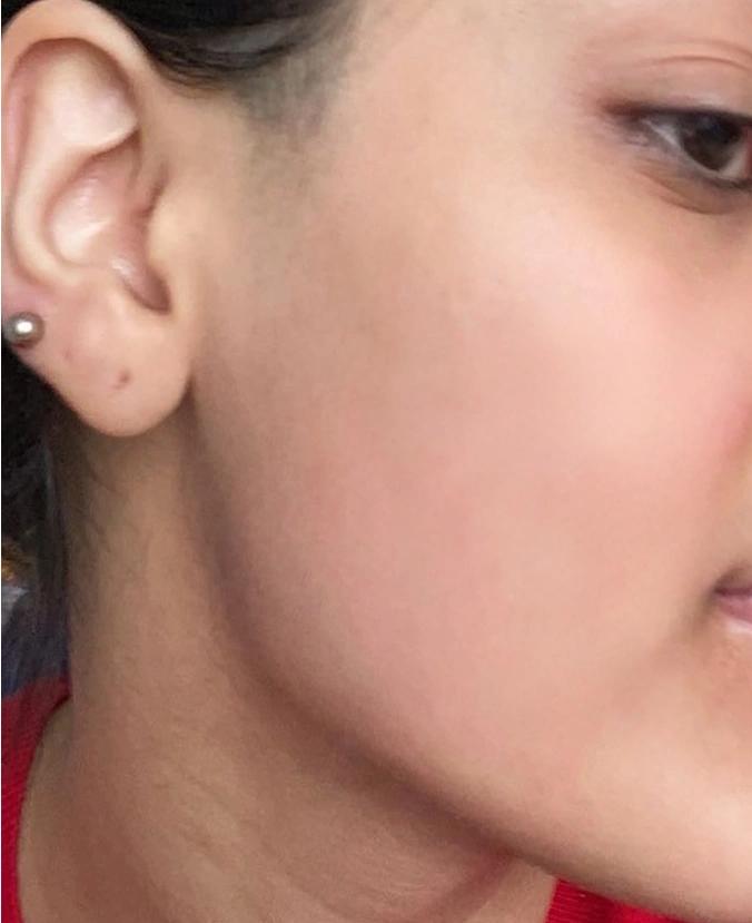 After treatment