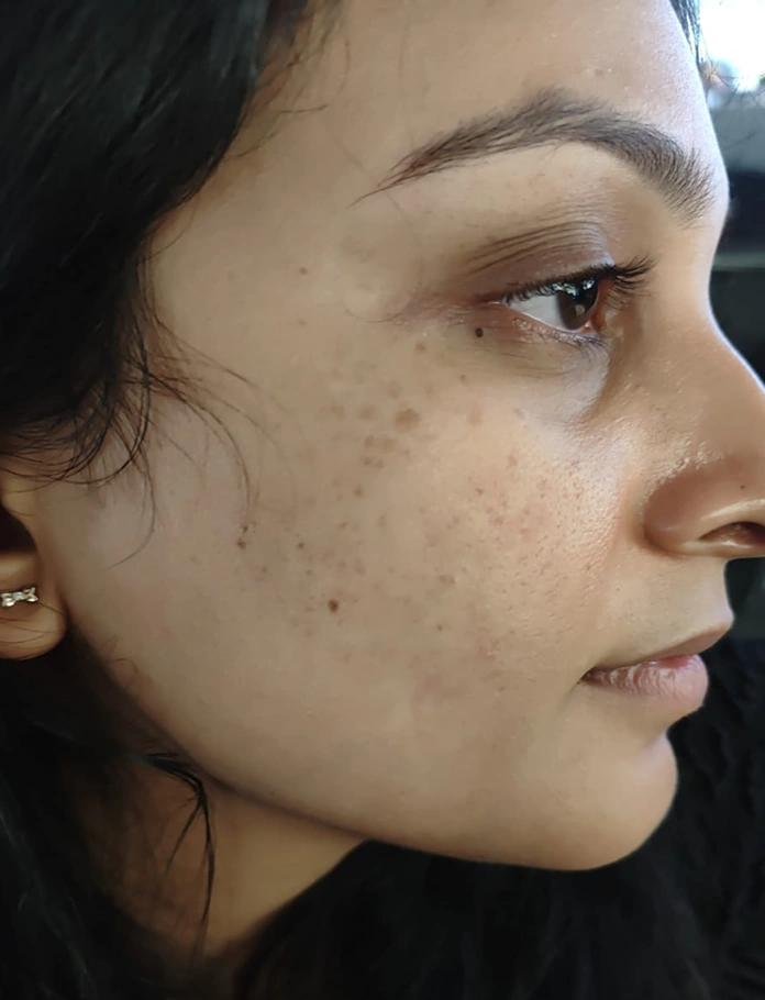 After treatment