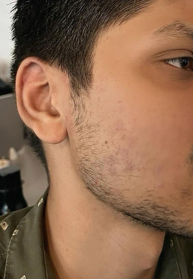 After treatment