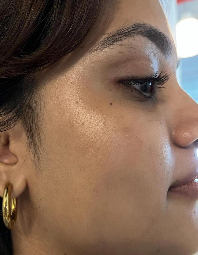 After treatment
