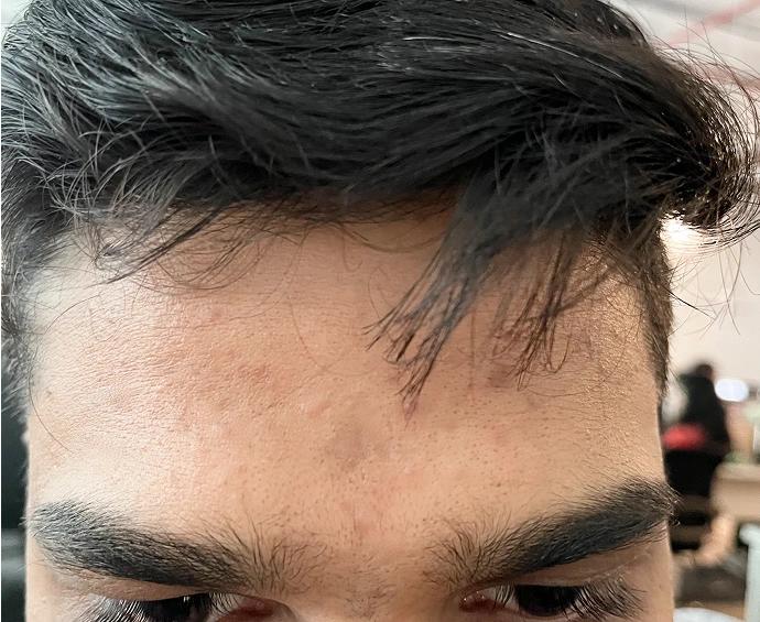 After treatment