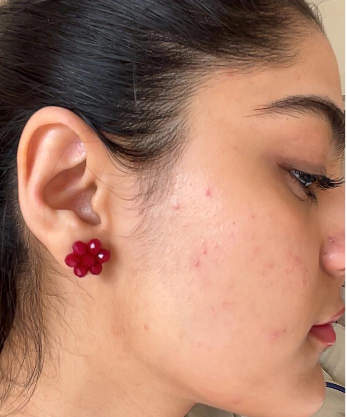 Before treatment