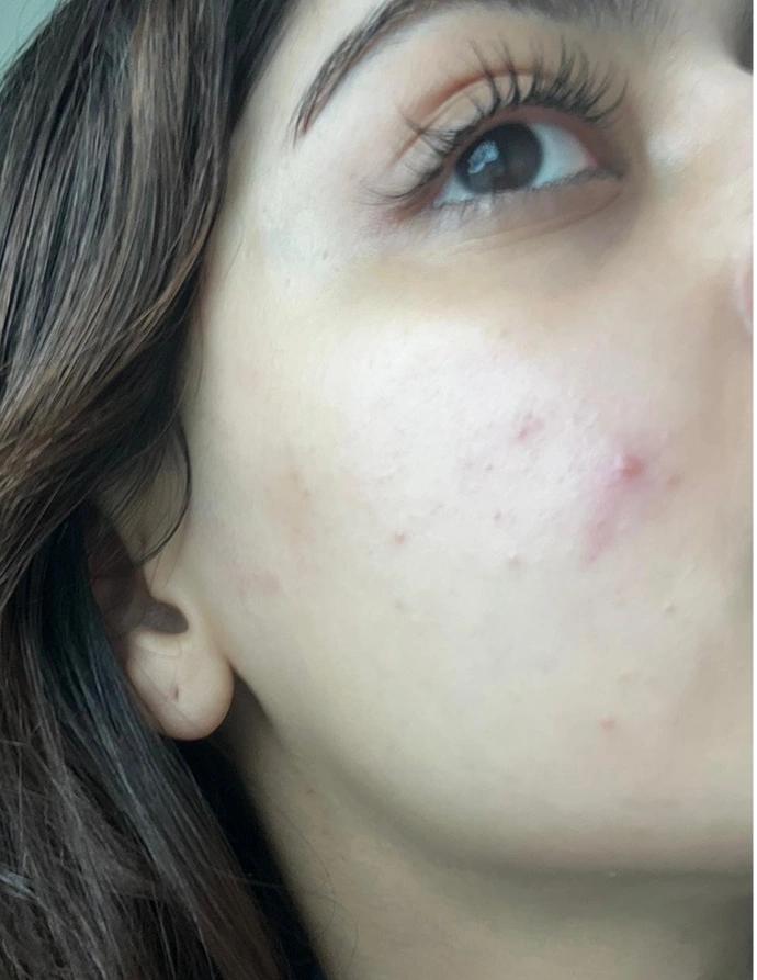 Before treatment