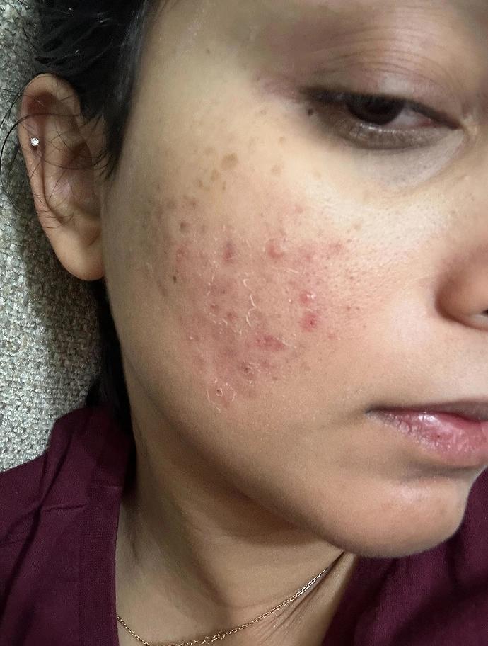 Before treatment