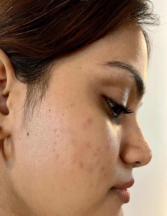 Before treatment