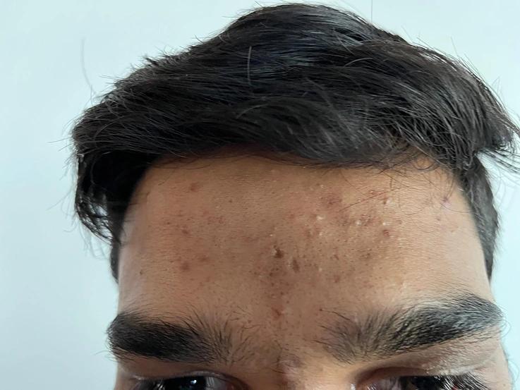 Before treatment