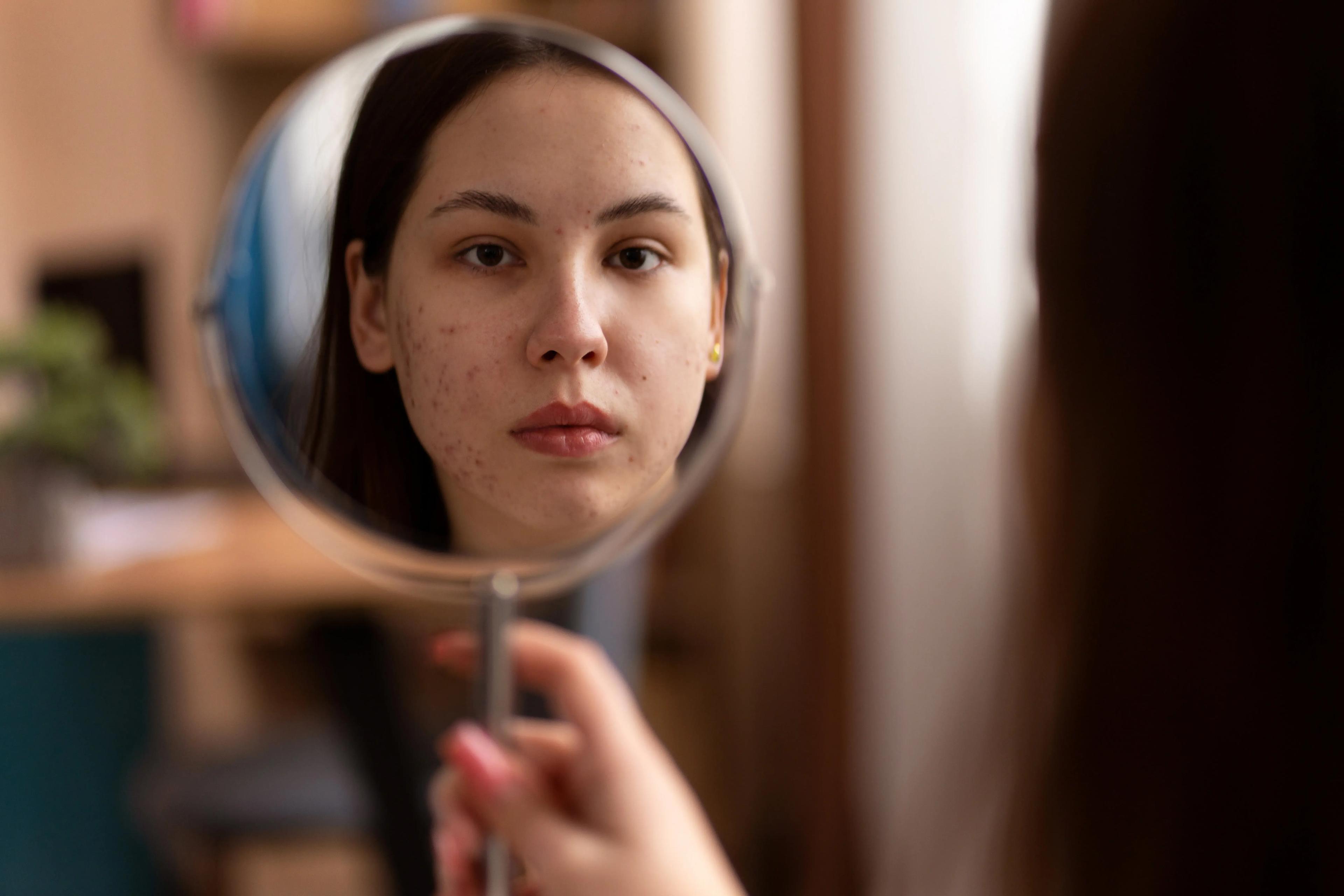 Inflamed pustules acne with visible whiteheads on skin