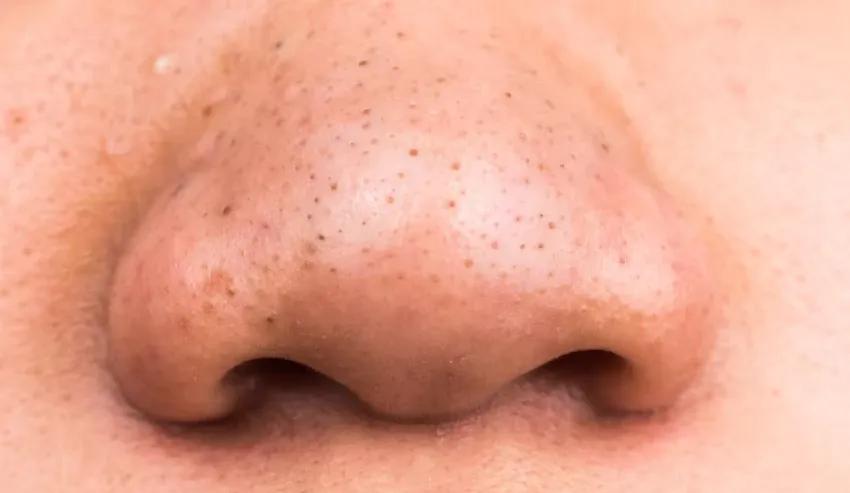 Blackheads common in Indian skin types