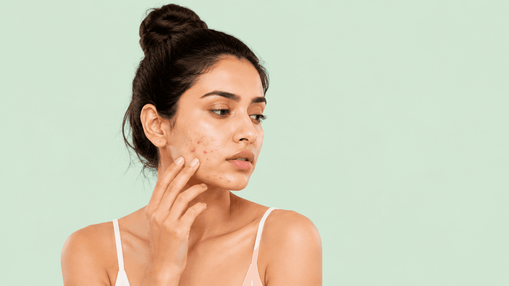 Acne Vulgaris: Definition, Causes, and Best Treatment Options