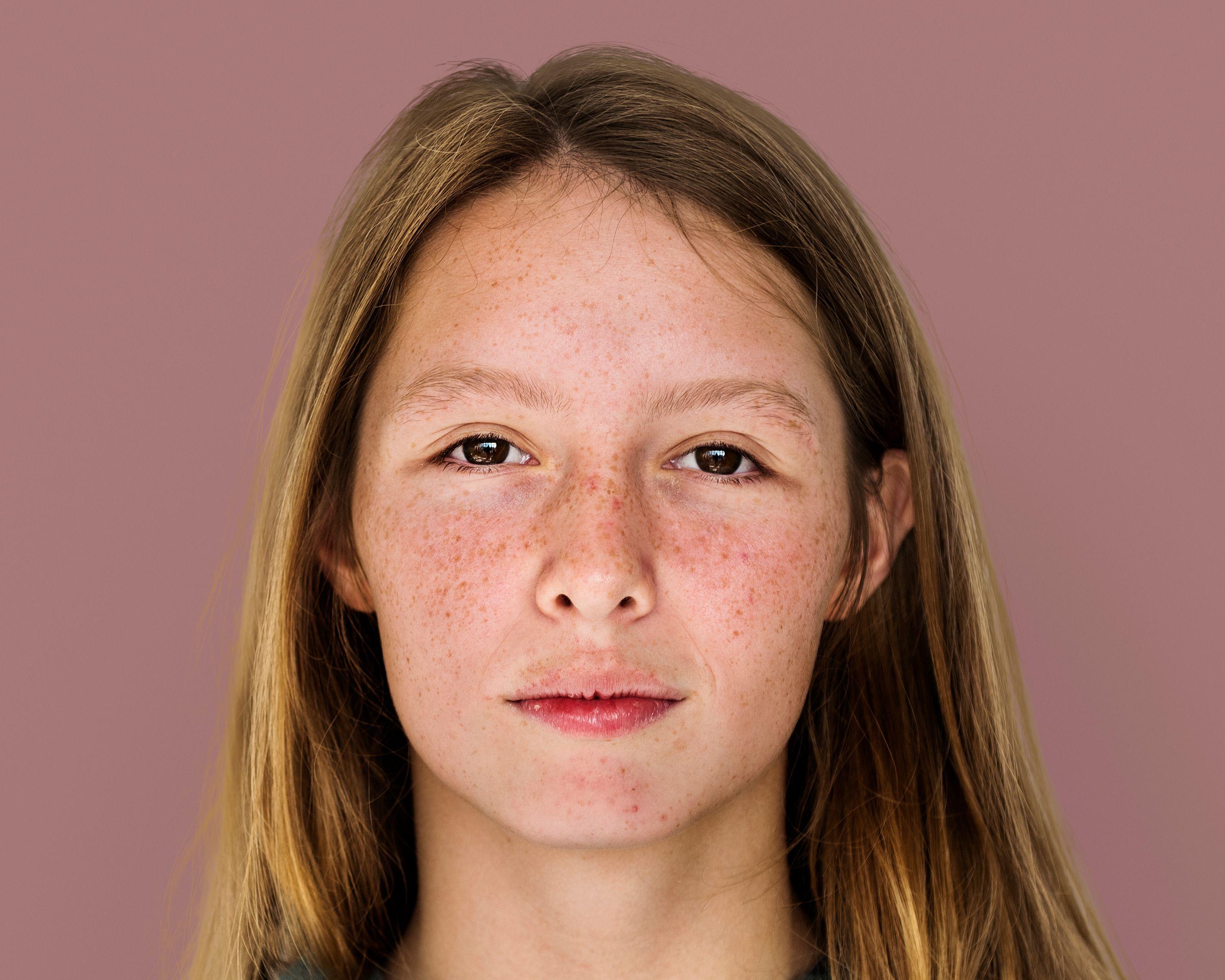 Cystic acne on cheeks and forehead areas