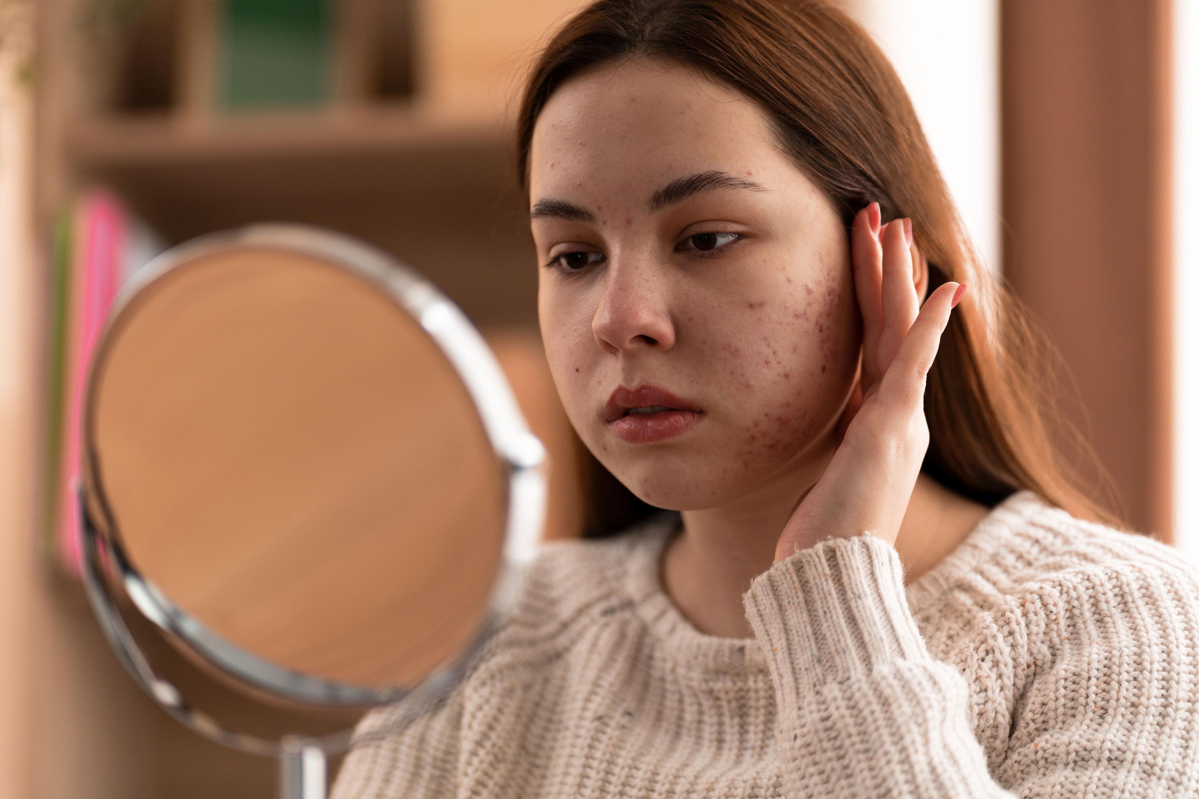 Hormonal pimples and treatment options