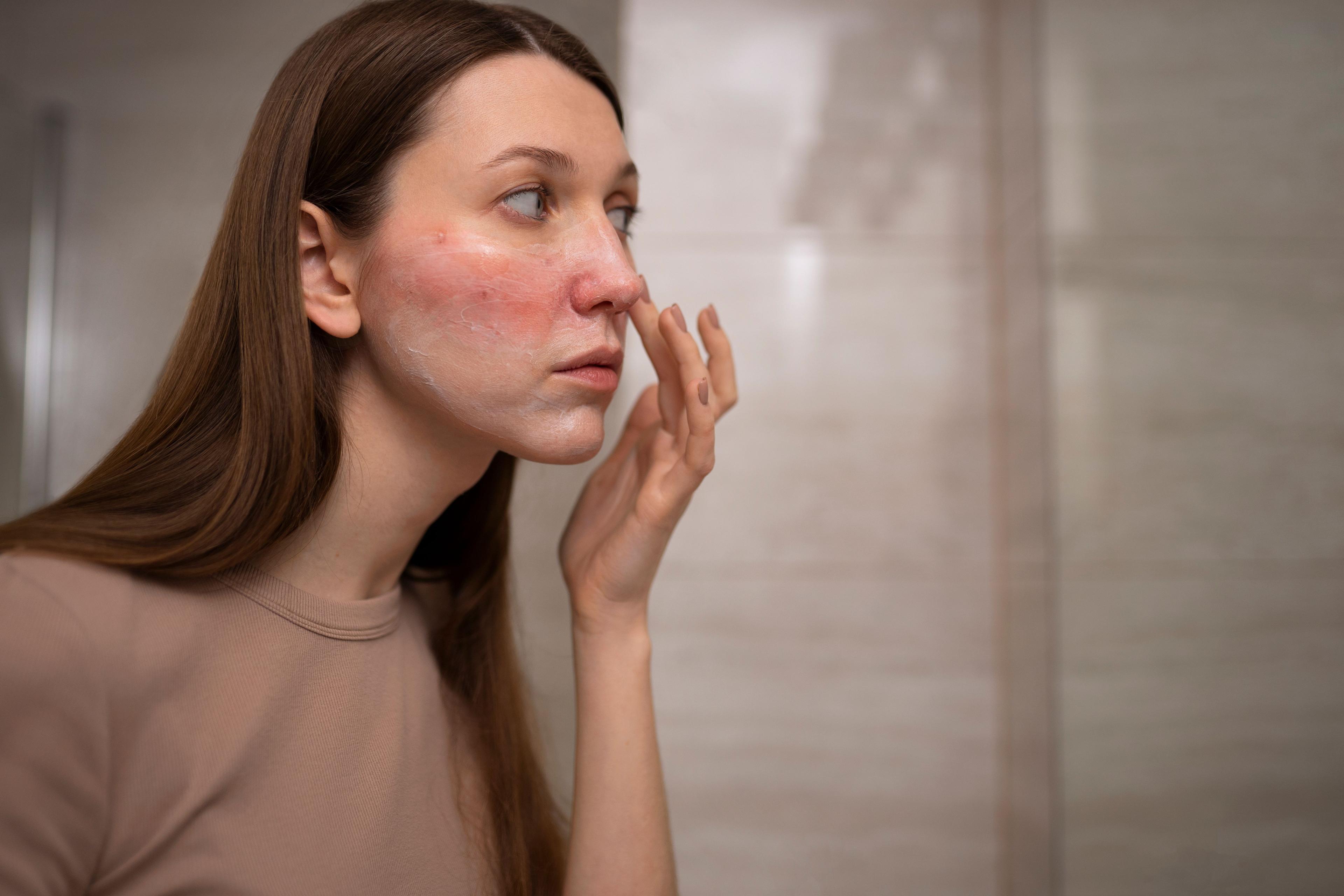 Signs and symptoms of acne-prone skin