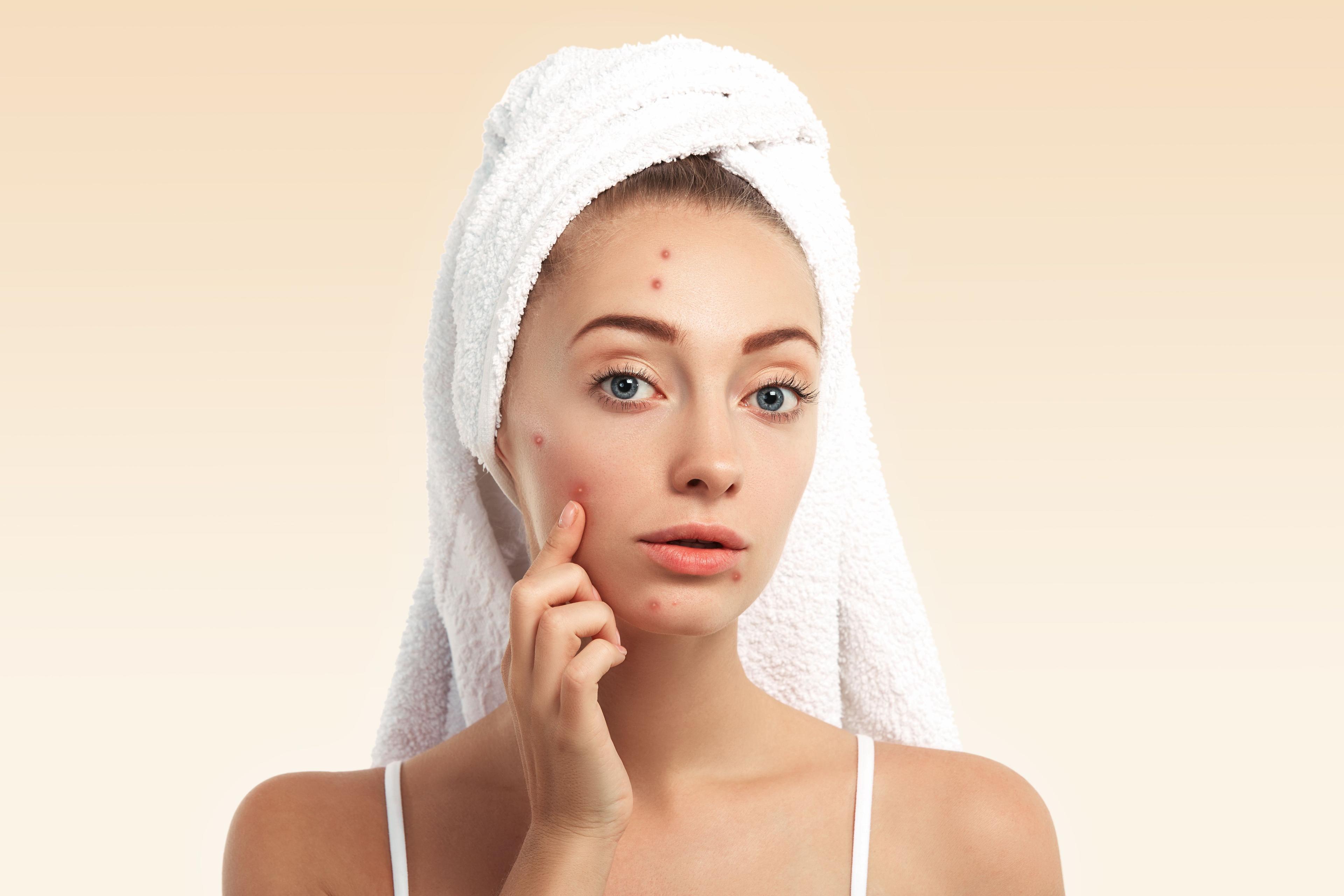 Sebum production and blackheads