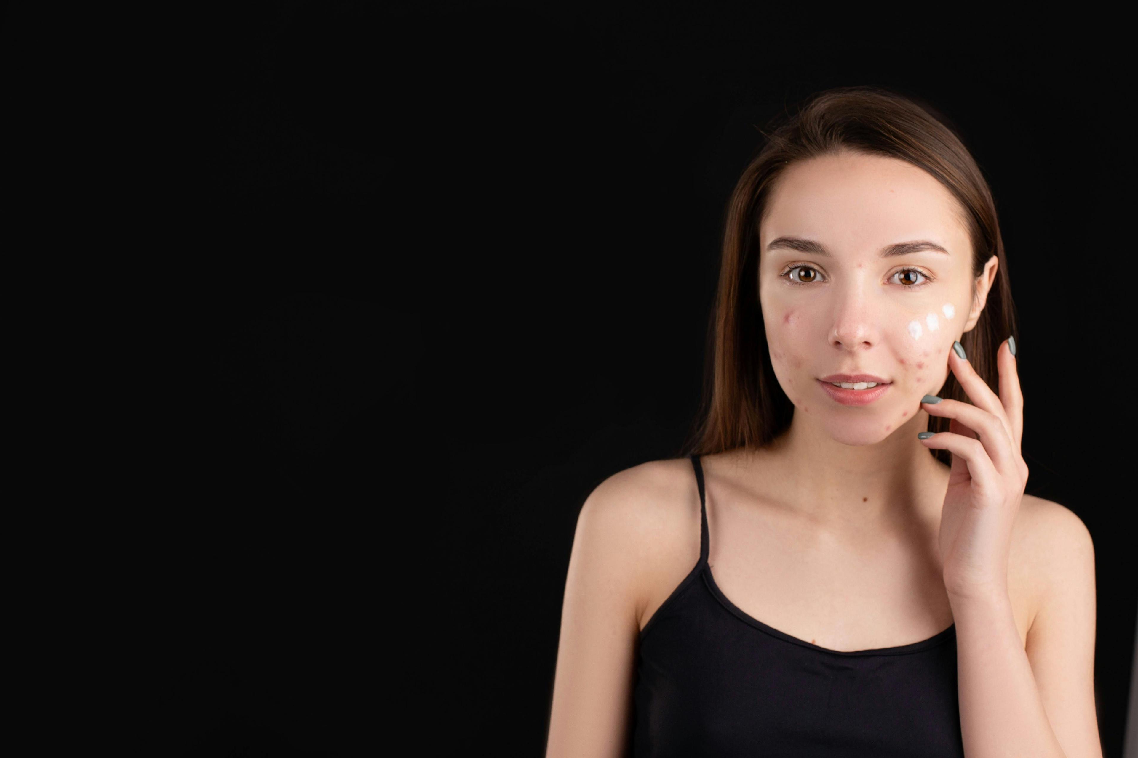 Overview of pimples causes and treatments