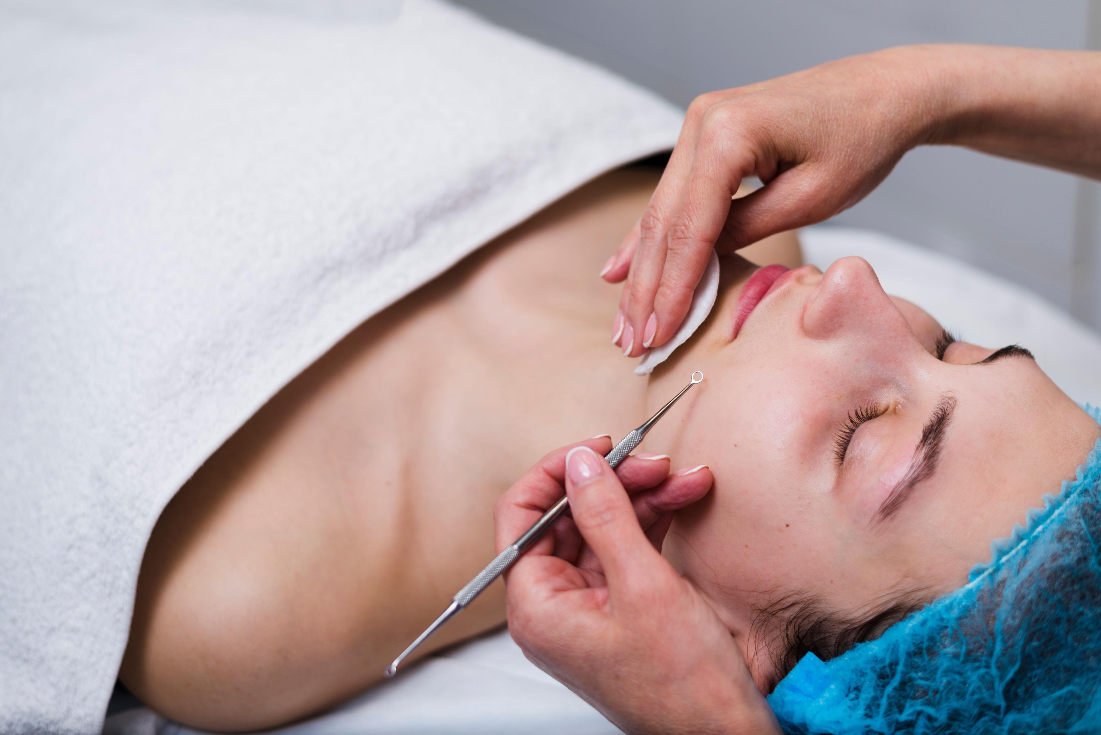 Pimples after threading treatment