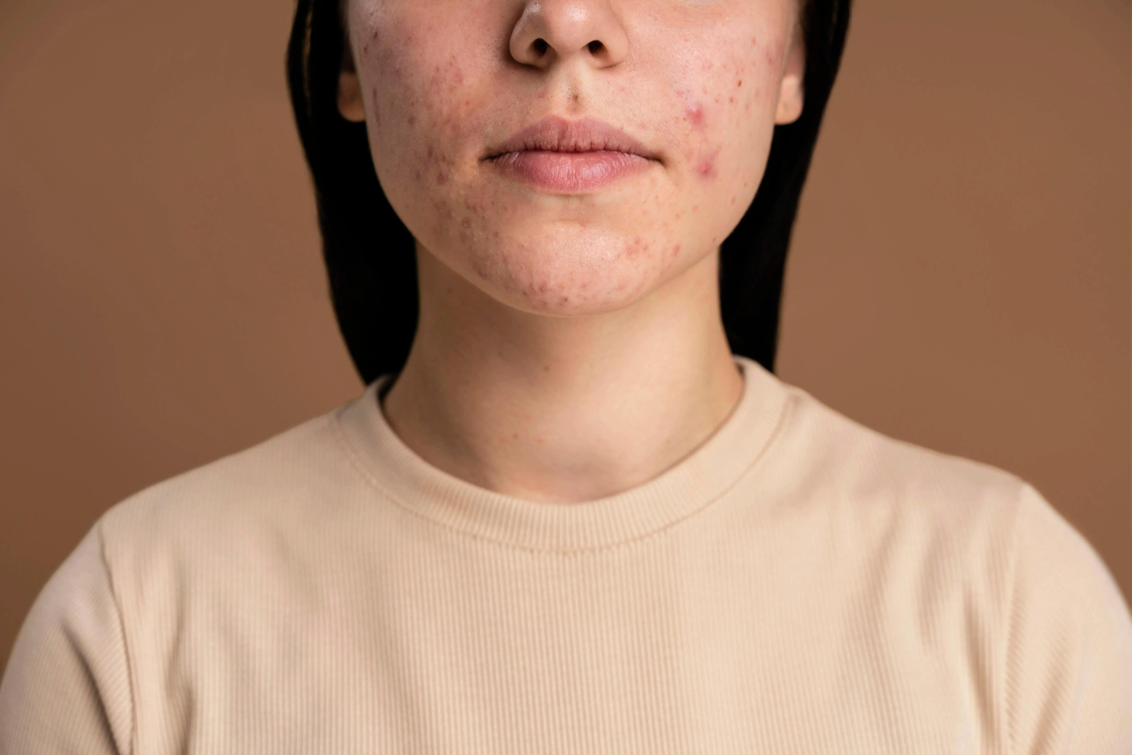 Hormonal acne breakouts on jawline with skincare routine concept