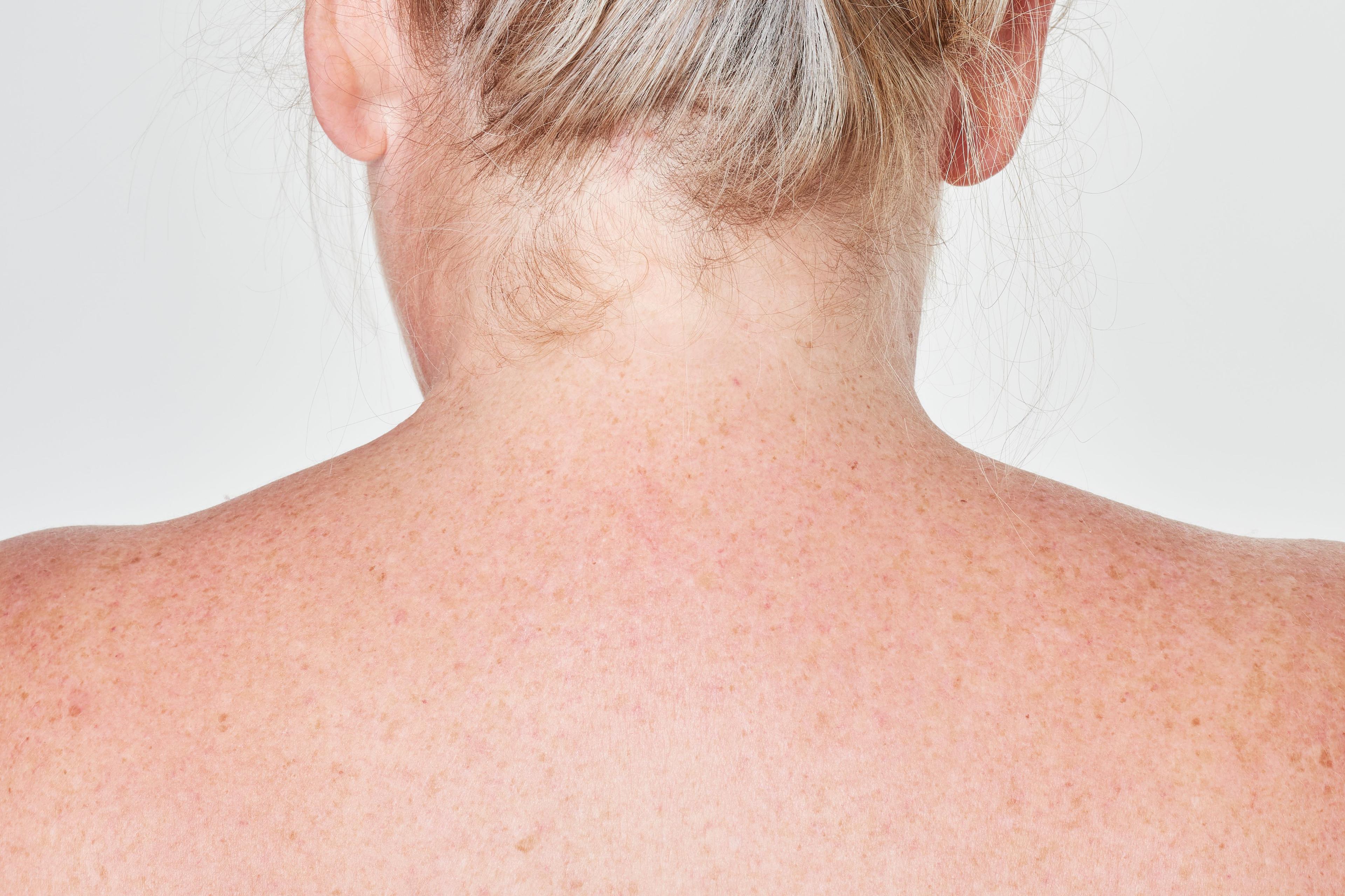 Hair products like shampoo, conditioner and hair oil contributing to back acne (bacne) on the skin