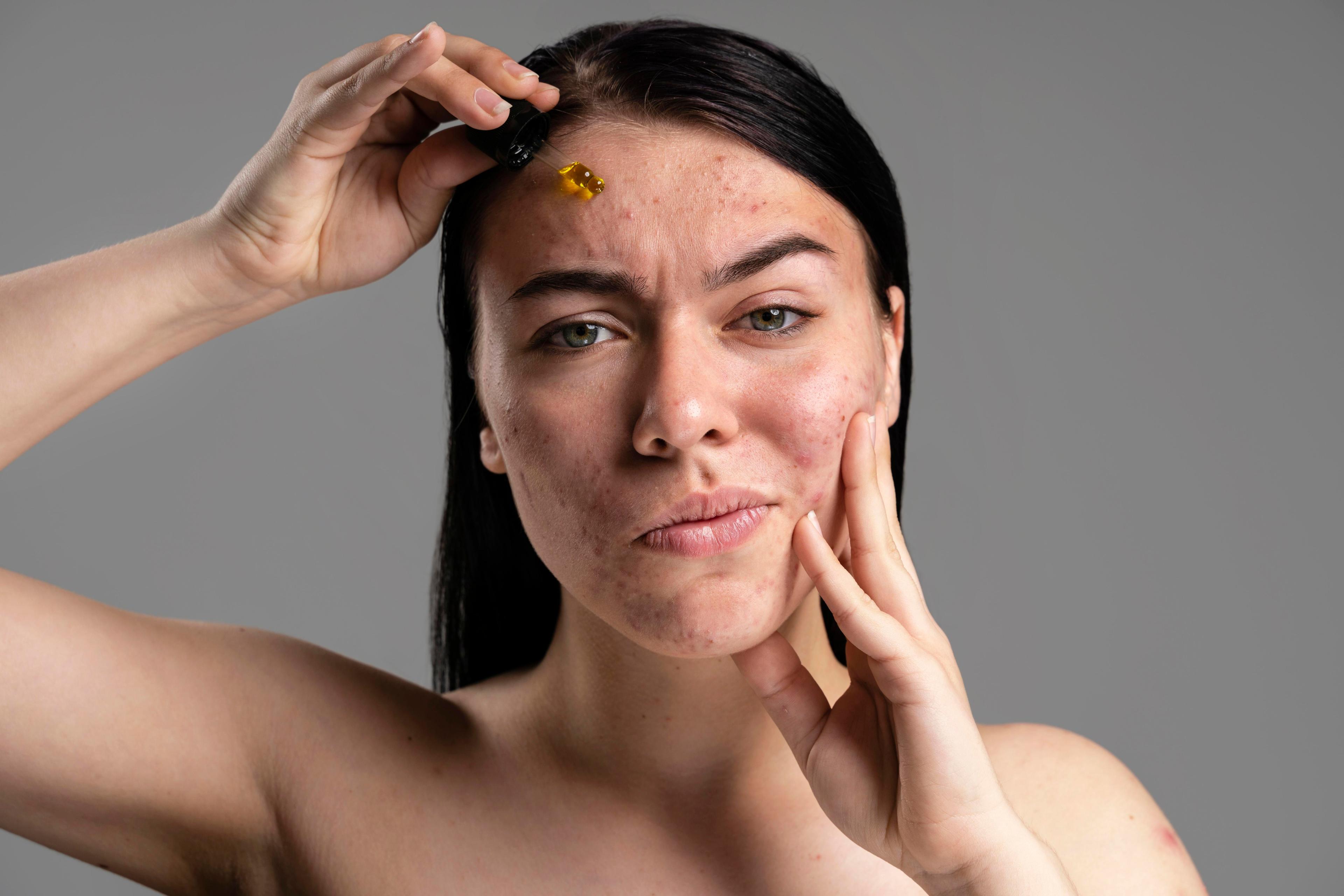 Nodular acne vs cystic acne comparison