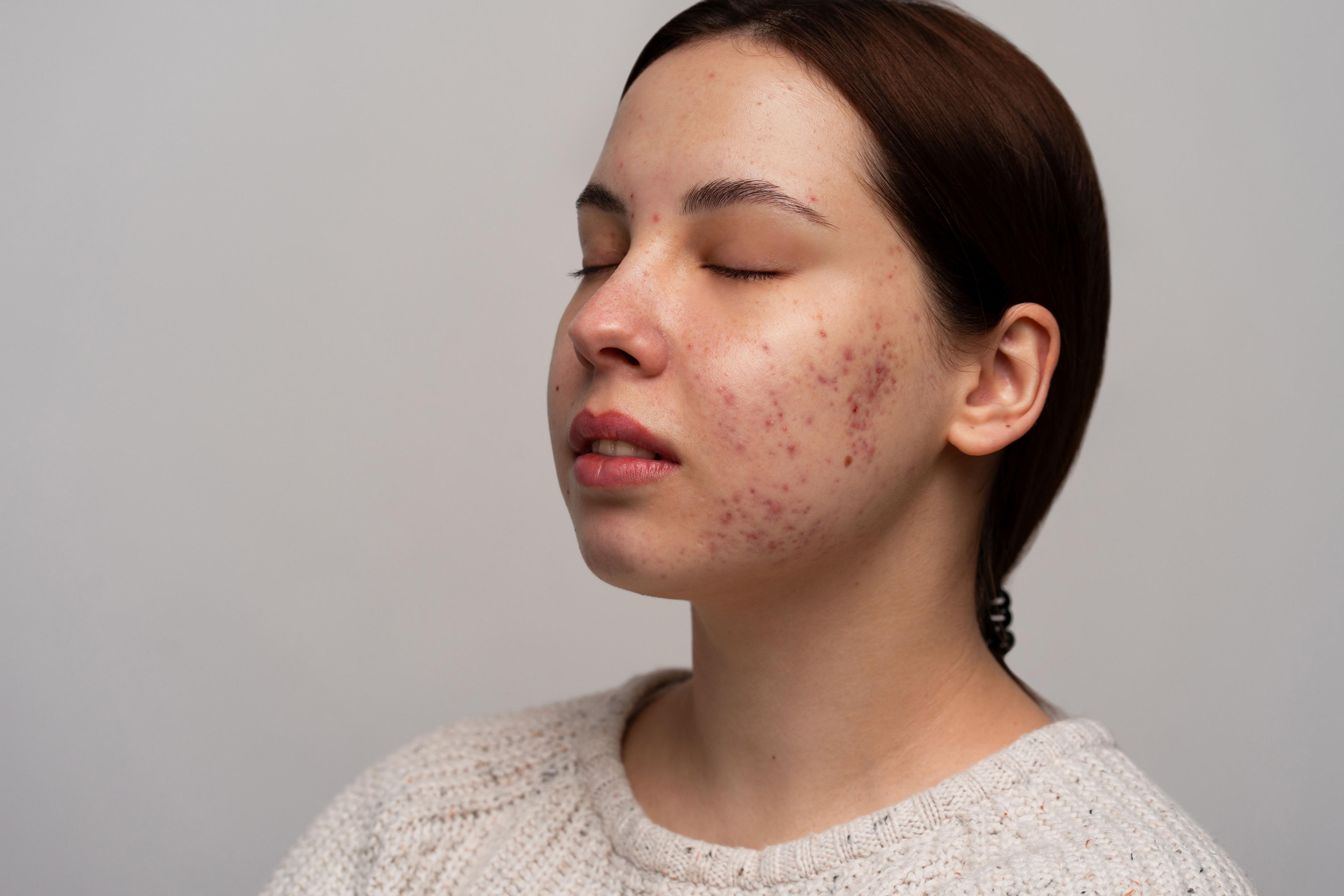 Pus-filled acne with treatment approach
