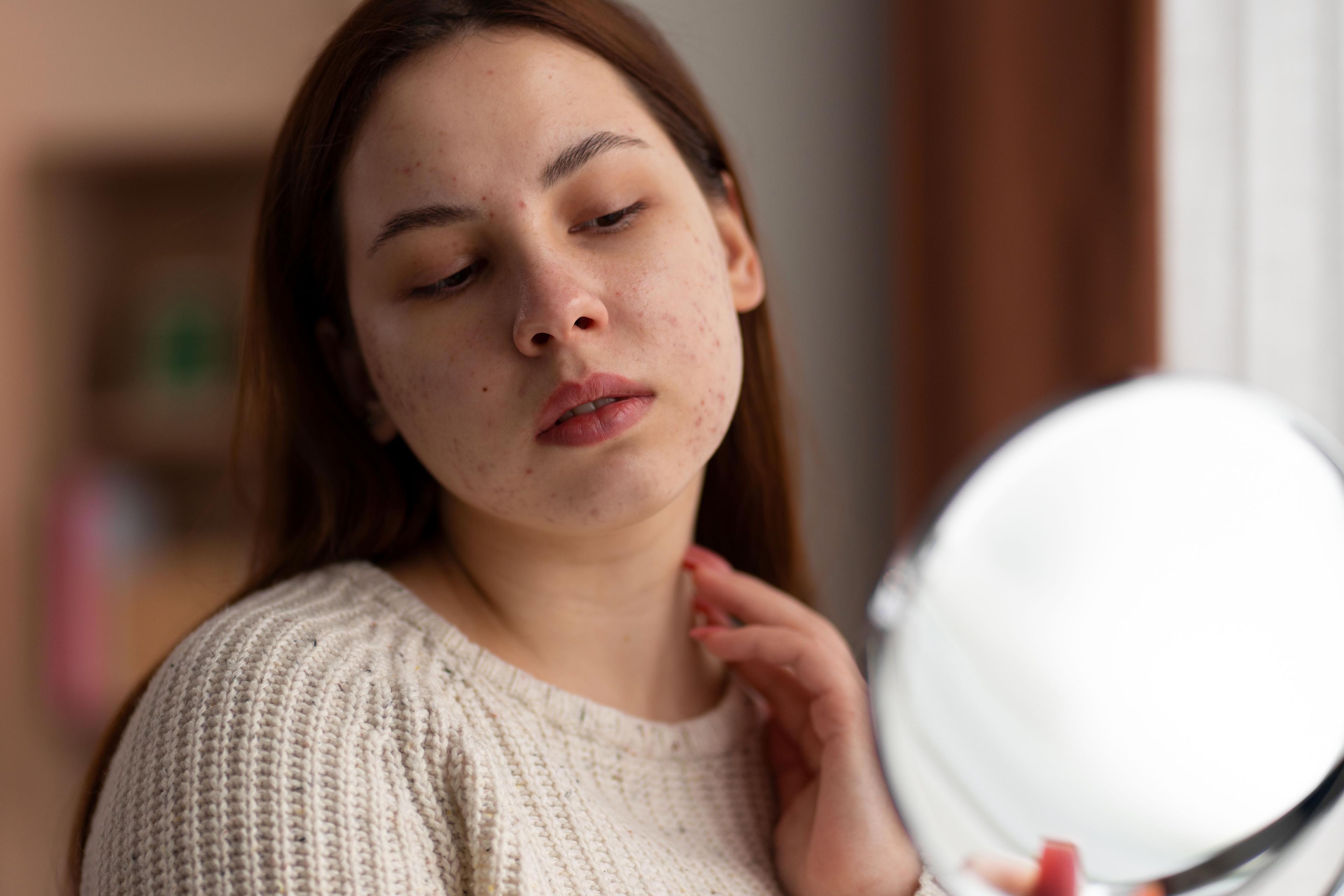 Sleeping late and acne breakouts