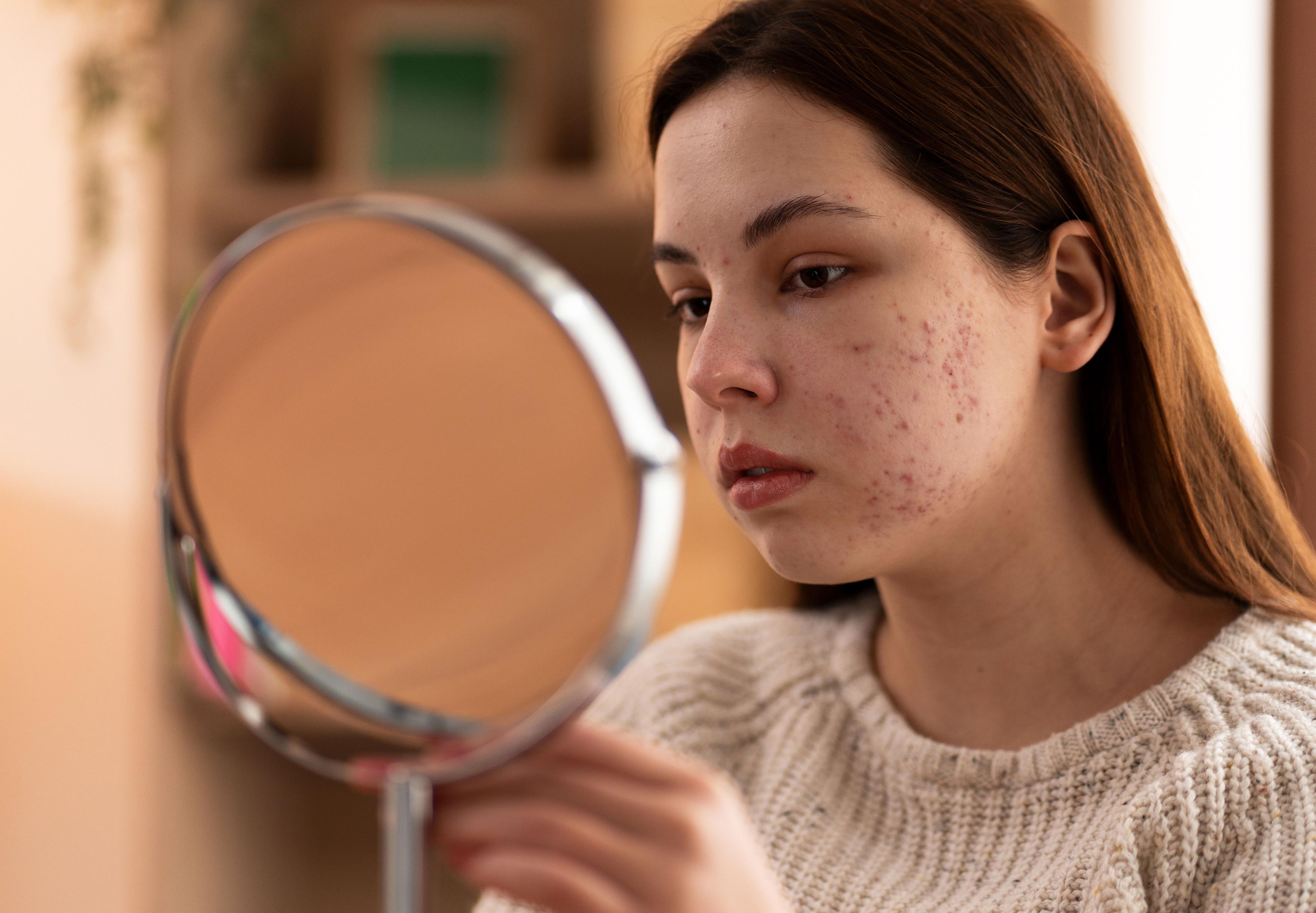 Impact of antibiotics leading to fungal acne on skin
