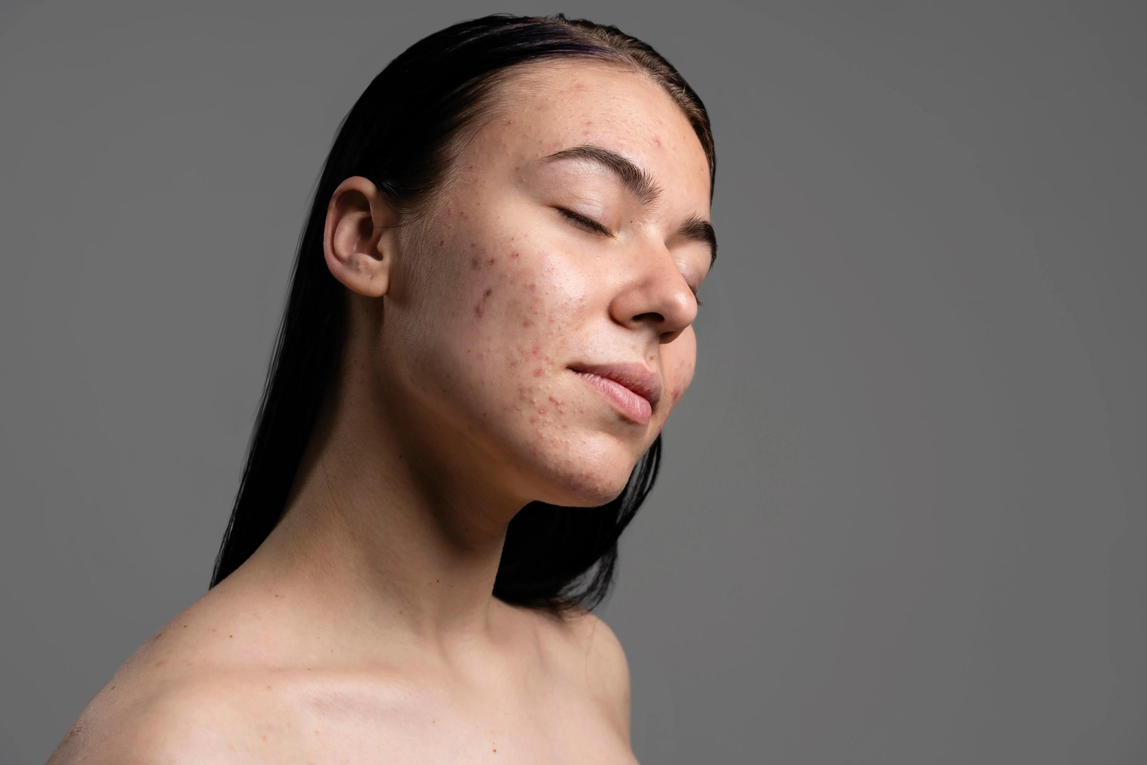 What is Acne
