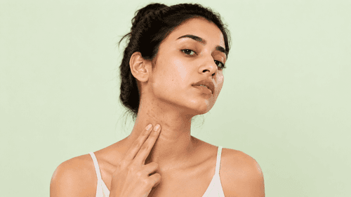 Acne on Neck: Why It Appears and How to Treat It by Cause