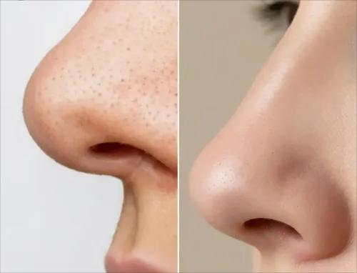 Blackheads vs Sebaceous Filaments: How to Tell the Difference