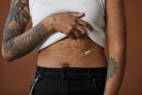 Understanding Body Acne: Causes, Triggers and Treatments