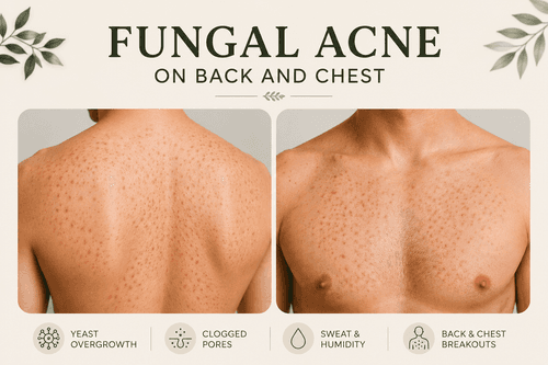Fungal Acne on Back and Chest