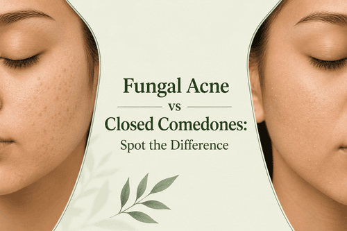 Fungal Acne vs Closed Comedones: Spot the Difference