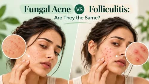 Fungal Acne vs Folliculitis: Are They the Same?