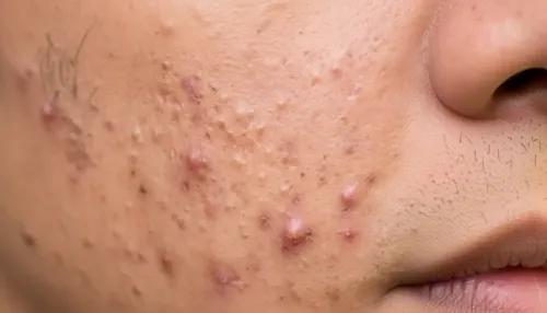 Papules Acne: Causes, Symptoms, Treatment & Prevention
