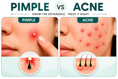 Pimple vs Acne: What’s the Real Difference?