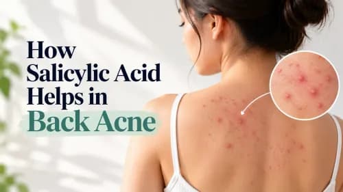 Salicylic Acid for Back Acne: How It Works and How to Use It