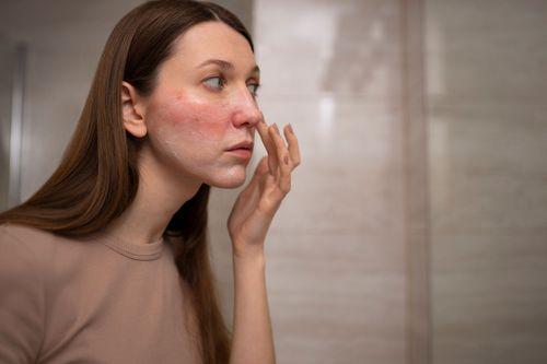 Symptoms of Acne Prone Skin