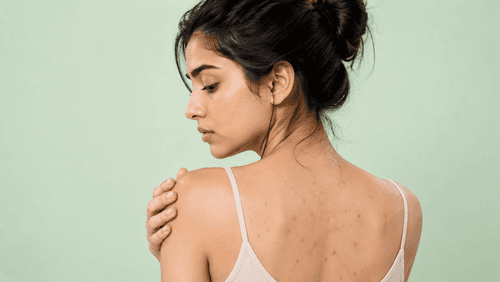 What Is the Role of Hair Products in Causing Back Acne?
