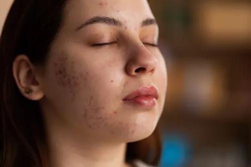 The Complete Guide to Acne Treatments: Medical, Natural, and In-Clinic Solutions