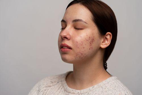 Pus-Filled Pimples: What They Mean & How to Treat Them
