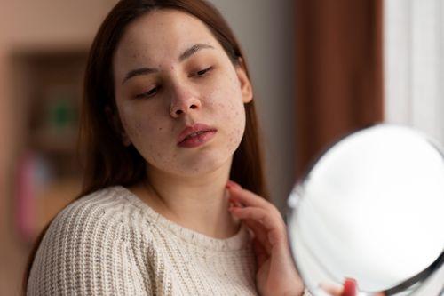 Does Sleeping Late Cause Acne? The Sleep and Breakout Connection