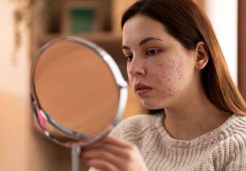 Antibiotics and Fungal Acne: Understanding the Link