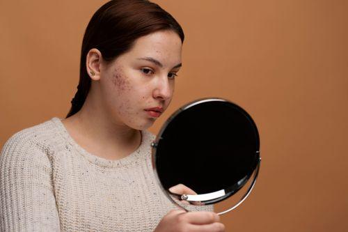Causes of Comedonal Acne: What Triggers Clogged Pores?