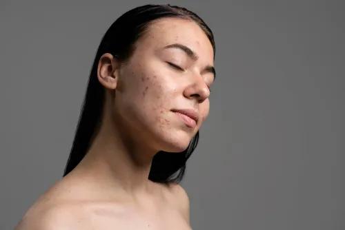 Acne: Types, Causes, Treatments and Prevention