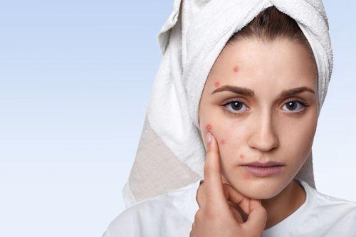 How Long Does a Pimple Take to Heal?